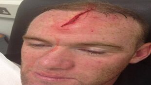 Wayne Rooney et son impressionante blessure